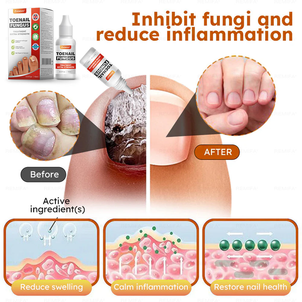 ✅ Made and shipped from the UK | Zvoevo® Extra Strength Toenail Fungus Treatment, Antifungal Solution for Toenails or Fingernails 🍀