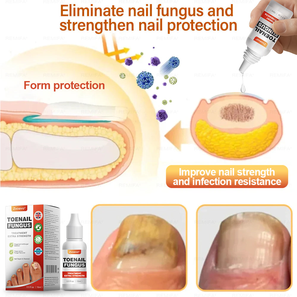 ✅ Made and Shipped from UK | Zvoevo® Toenail Fungus Treatment Extra Strength, Antifungal Solution for Toenail or Fingernail, Triple Action Formula for Remove Fungal, Repair and Renewal Damaged Nails 🍀